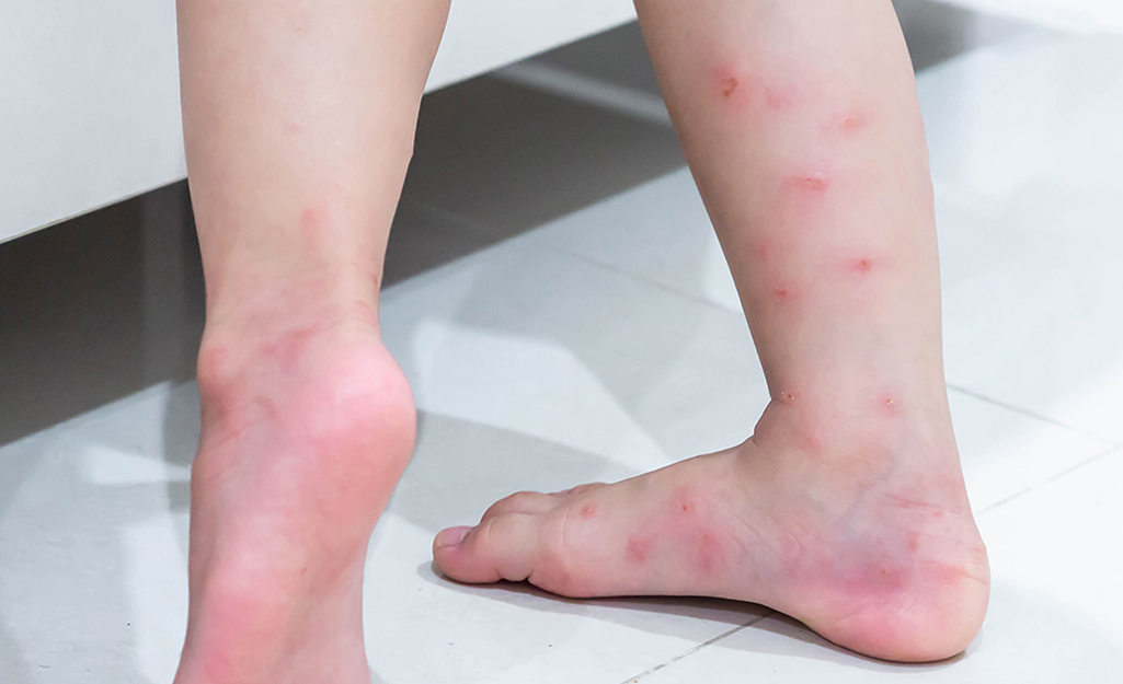 Close-up of legs covered in fire ant bites.