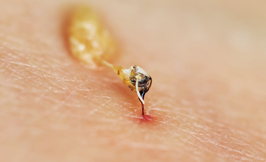 treatment for bumble bee sting